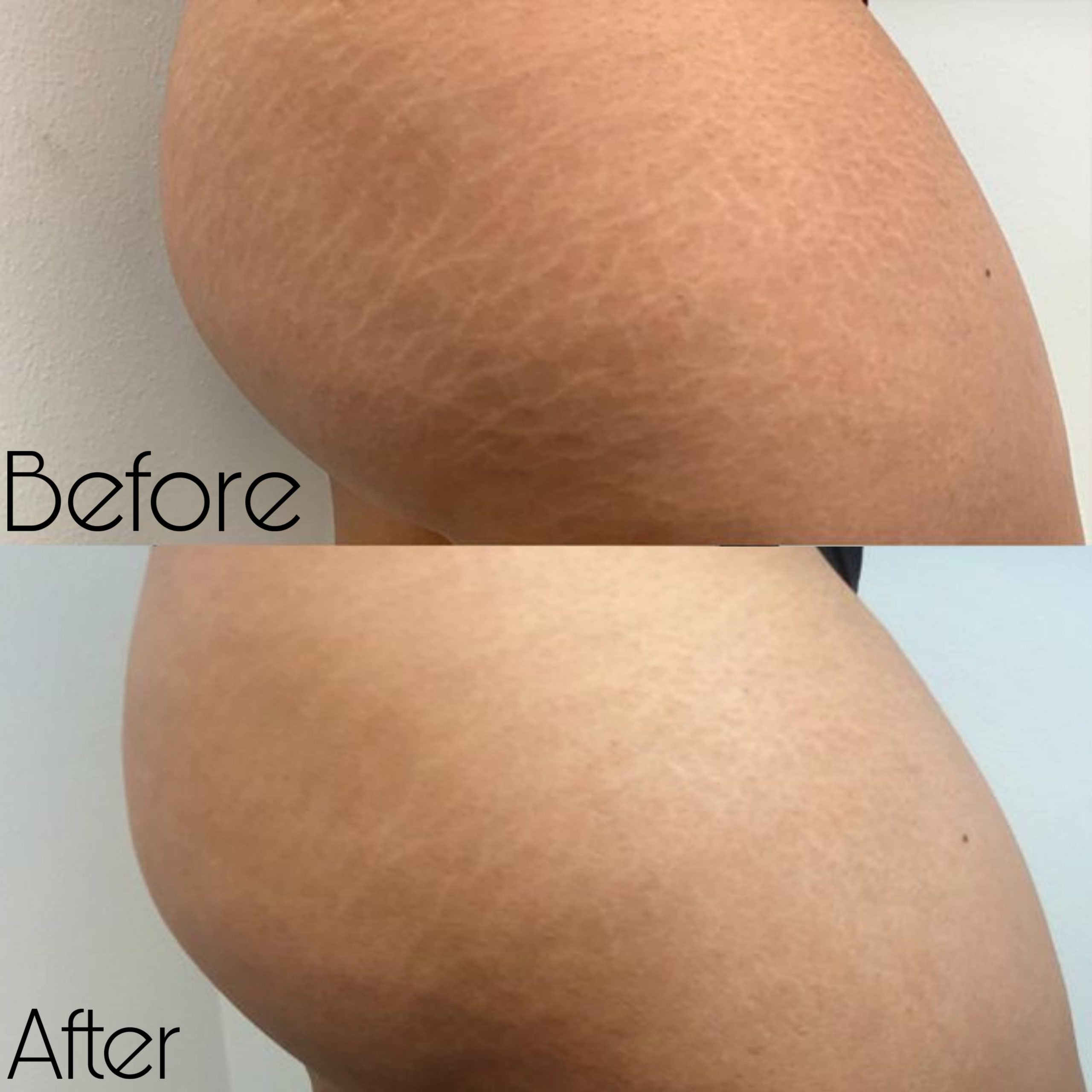 Abdominal Surgical Scars